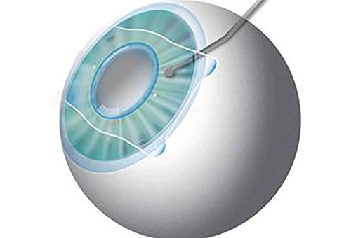 近视晶体植入模型示意图