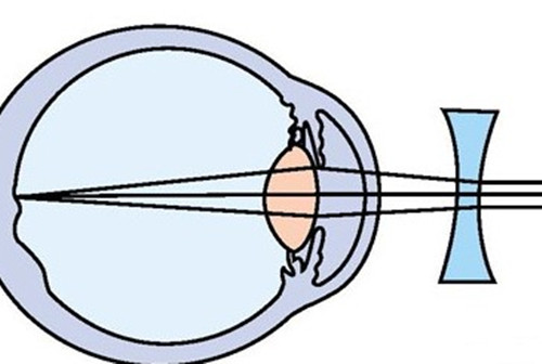 近视镜片矫正视力成像示意图
