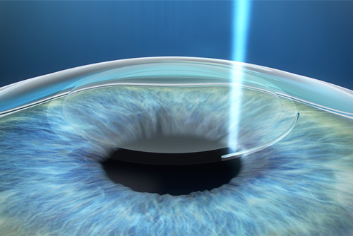 激光矫正近视示意图