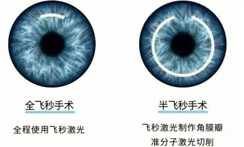 全飞秒手术和半飞秒手术对比图