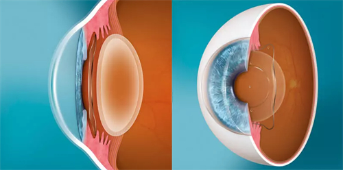 晶体植入的层次