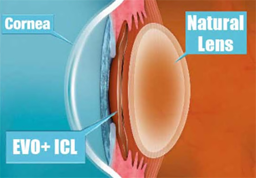 晶体植入手术演示图